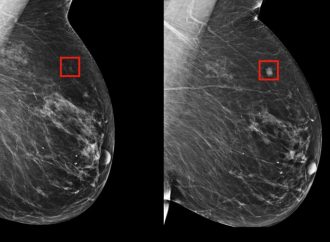 Inteligencia Artificial detecta el cáncer de mama hasta 4 años antes de su aparición